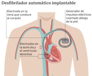 desfibrilador 2