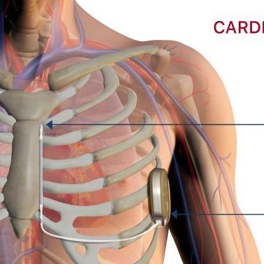Se realizó el primer implante de un cardiodesfibrilador subcutáneo EMBLEM S ICD en Santiago del Estero